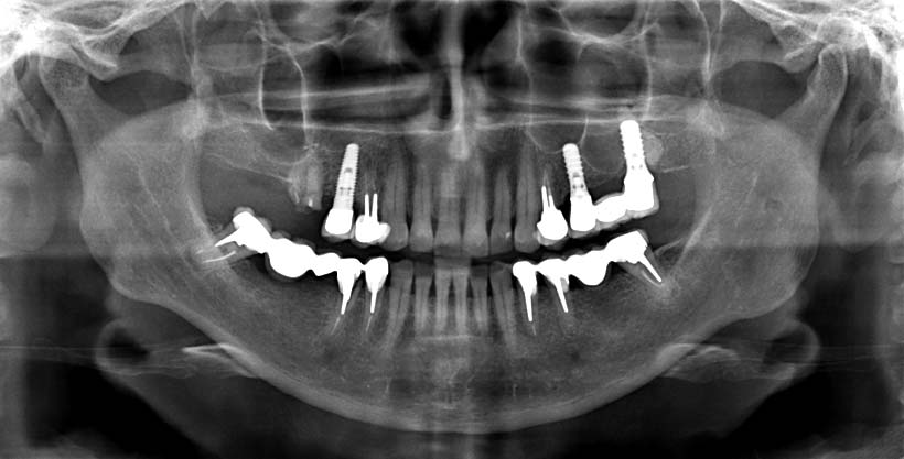 Ортопантомограмма зубочелюстной системы