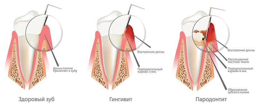 Здоровый зуб, гингивит, пародонтит